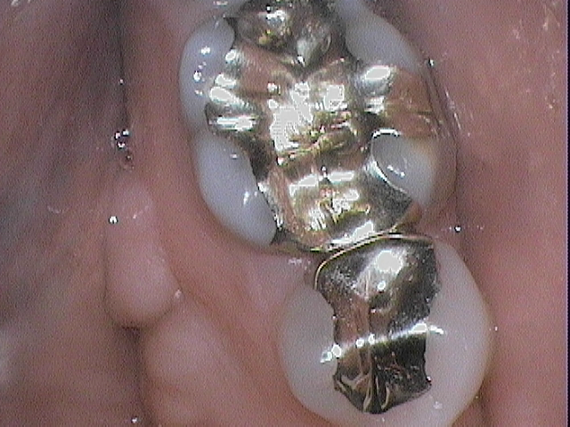 gold filling in tooth