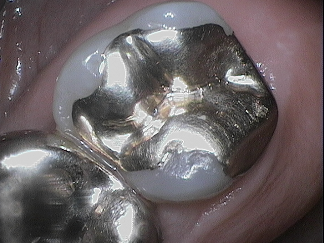 gold filling in tooth
